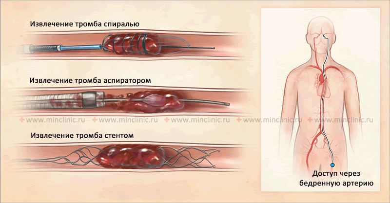 Эмболии сосудов головного мозга (церебральные эмболии) Виды устройств, используемых для механической тромбэктомии: спираль, аспирационное устройство, стент. Эндоваскулярное лечение церебральной эмболии осуществляется путём введения этих устройств через бедренную артерию.